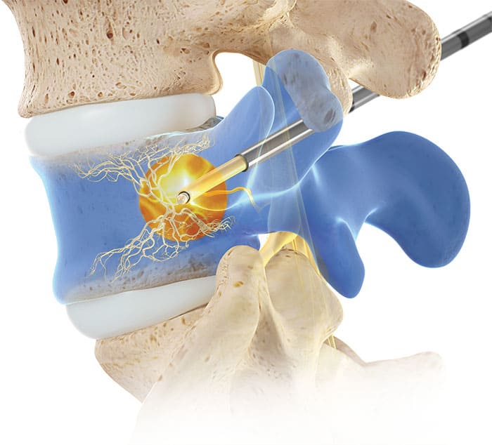 Relievant Intracept spine illustration